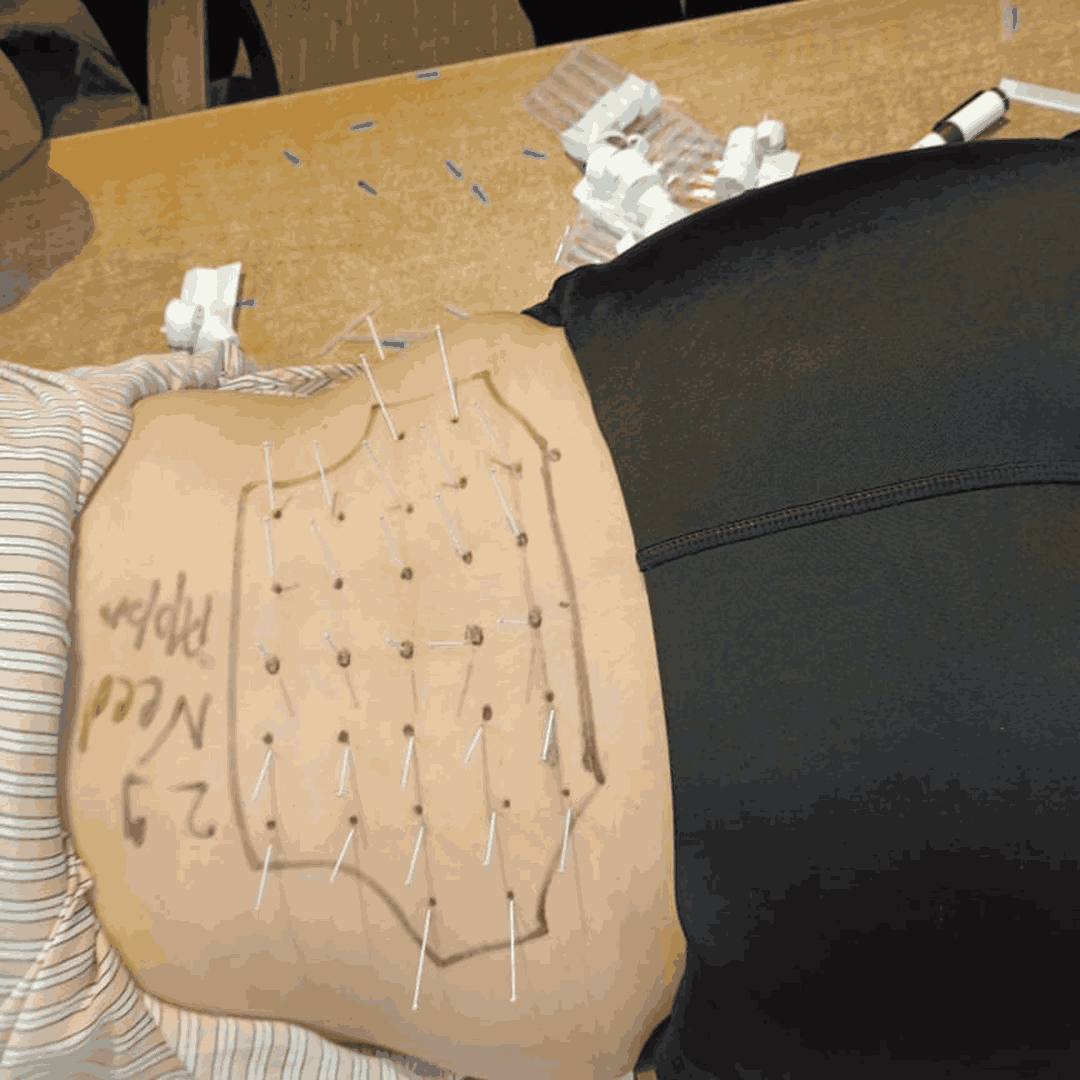 workshop-on-dry-needling (8)